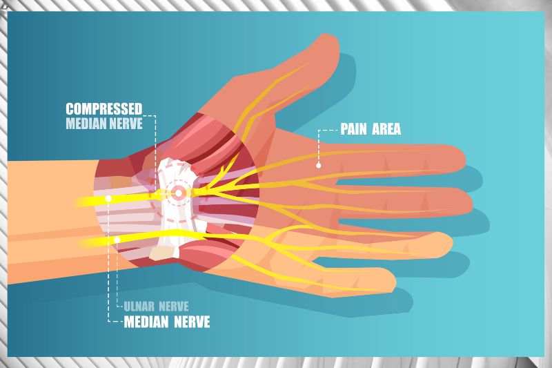 Beneath the Surface: Understanding How Carpal Tunnel  Syndrome Quietly Alters Lives